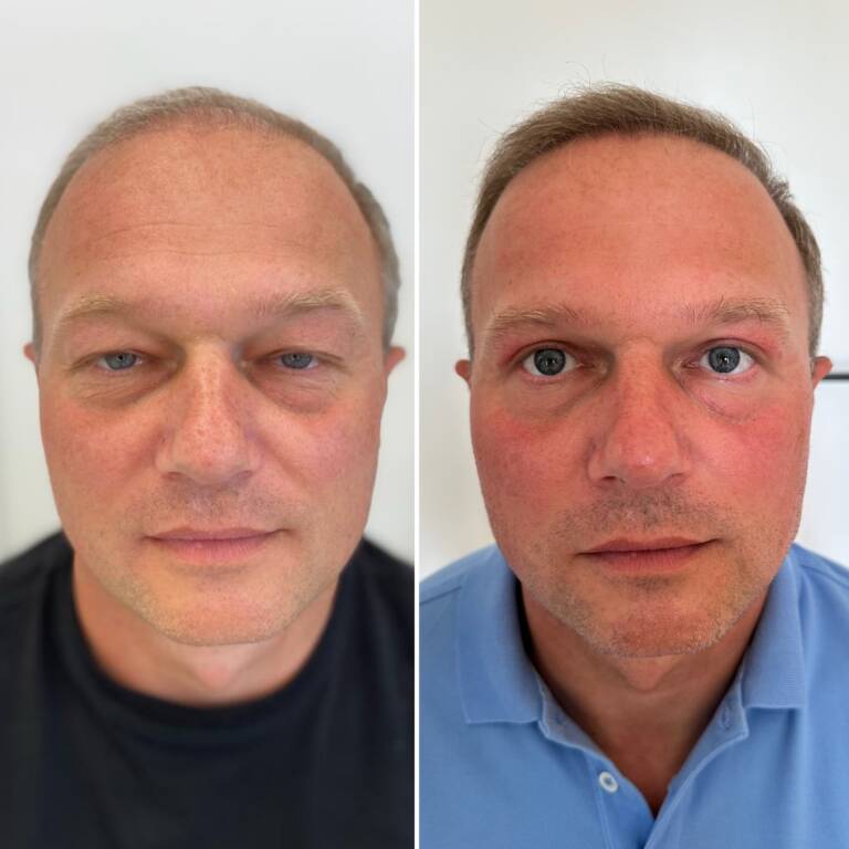 plastyka powiek górnych