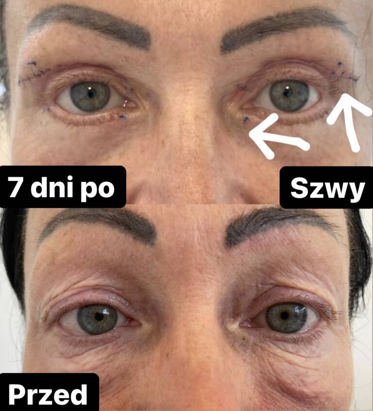 plastyka powiek górnych i dolnych