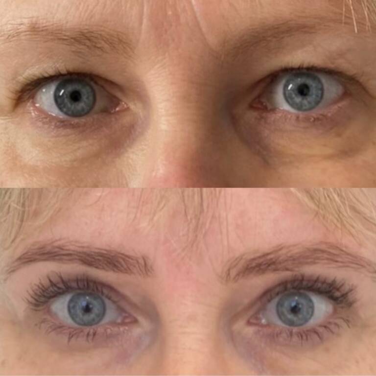 plastyka powiek górnych