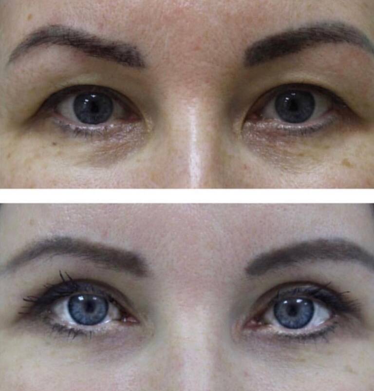 chirurgiczna korekcja powiek