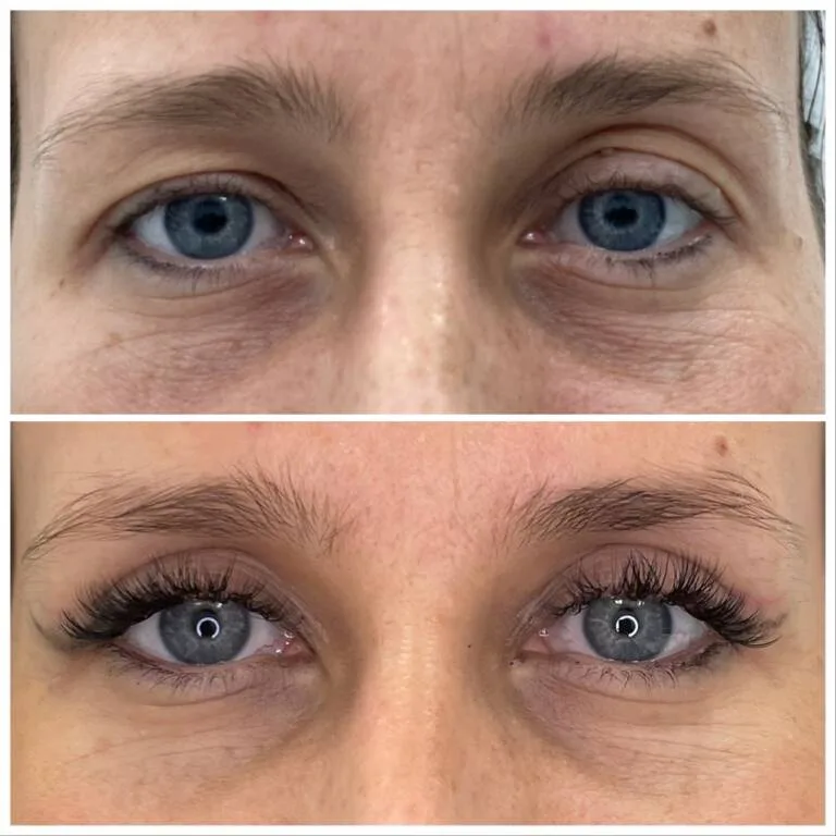 plastyka powiek dr czak wroclaw 2