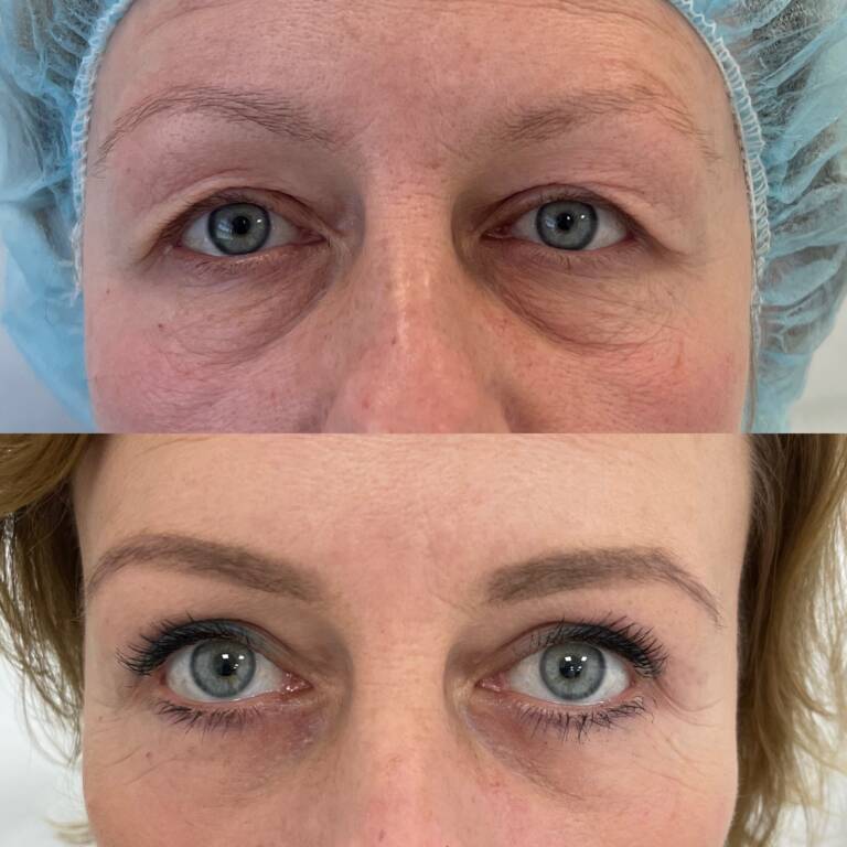 plastyka powiek gornych i dolnych 4