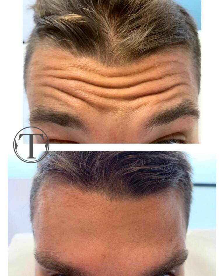 zmarszczki botox na czole wrocław