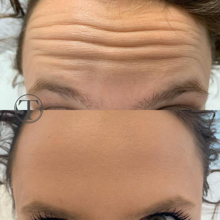 z zmarszczki botox wrocław