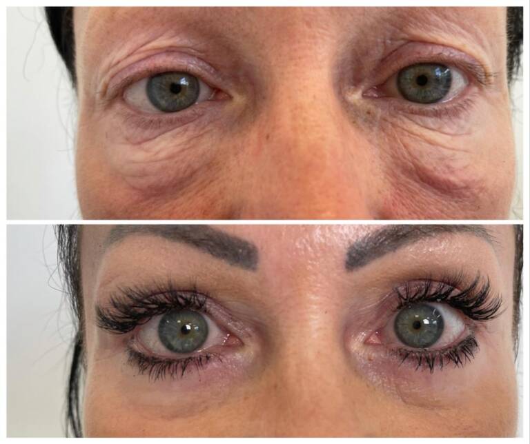 laserowa plastyka powiek górnych i dolnych