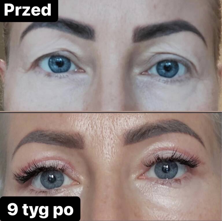 plastyka powiek górnych