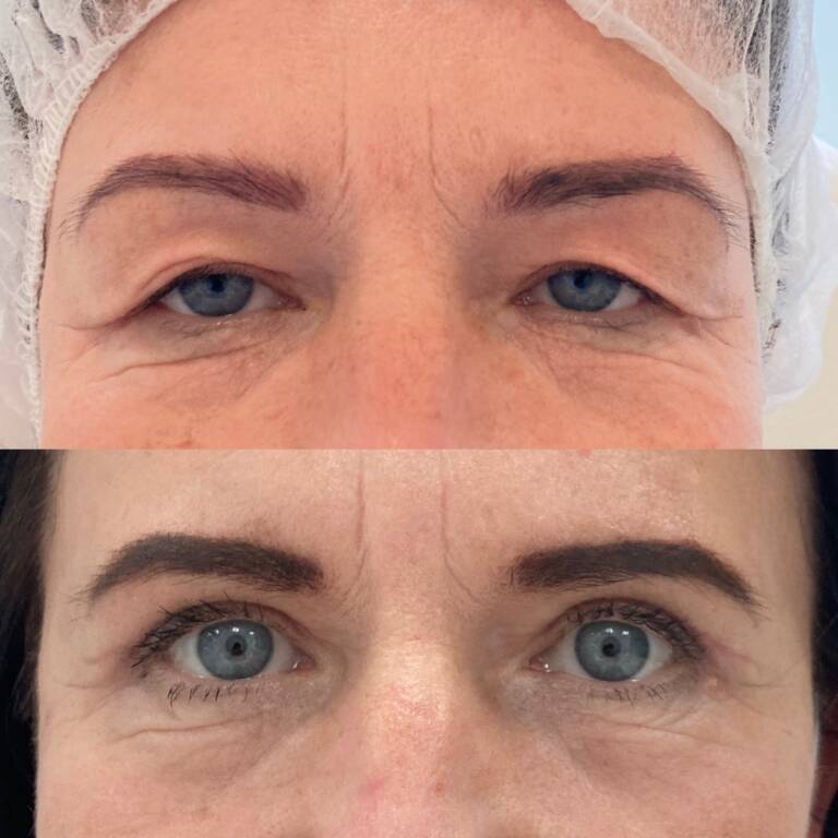 plastyka powiek górnych