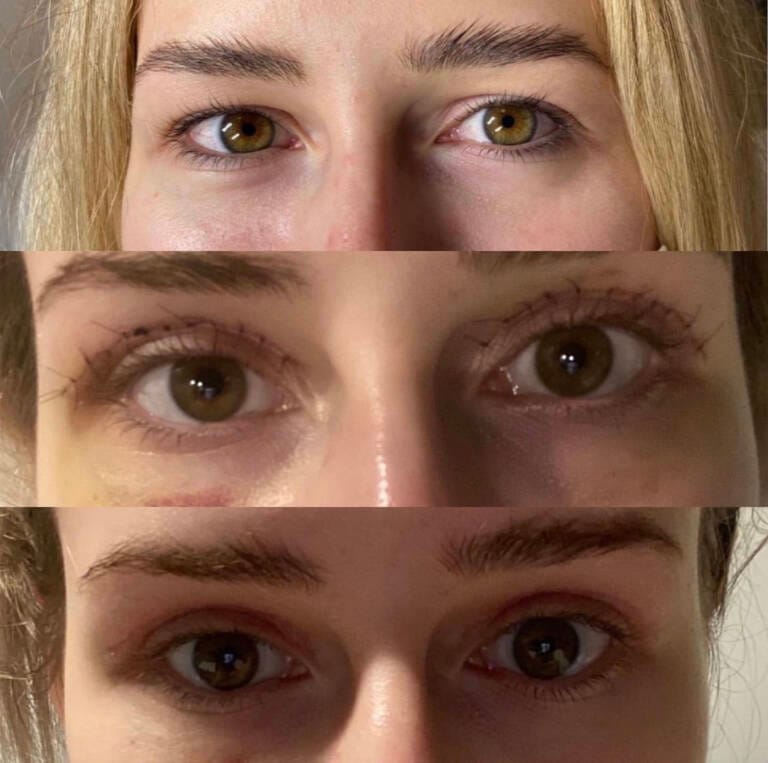 plastyka powiek górnych