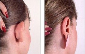 Otoplastyka – chirurgiczna korekta uszu