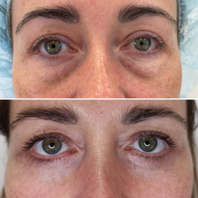 plastyka powiek dolnych wrocław