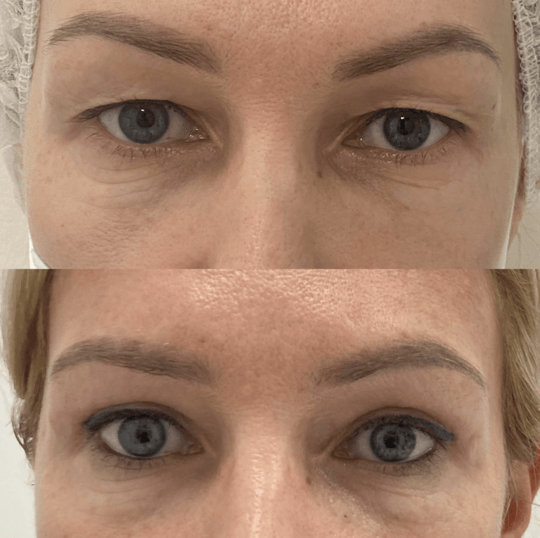 plastyka powiek górnych