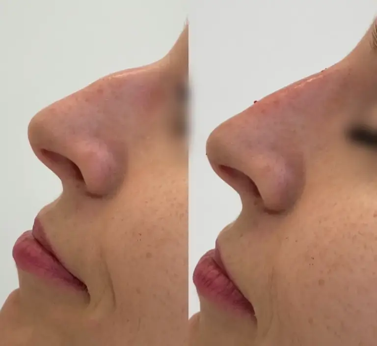 Korekta nosa kwasem hialuronowym-1