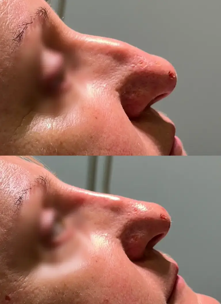 Korekta nosa kwasem hialuronowym-2