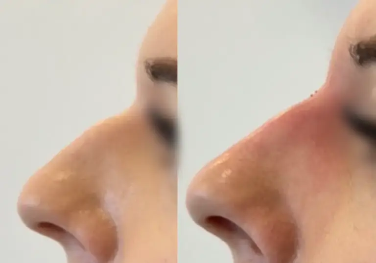 Korekta nosa kwasem hialuronowym