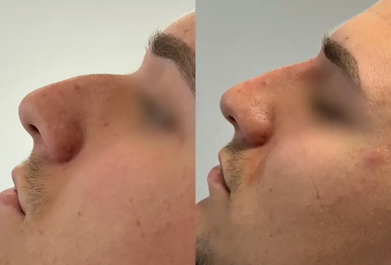 Korekta nosa kwasem hialuronowym efekty wrocław