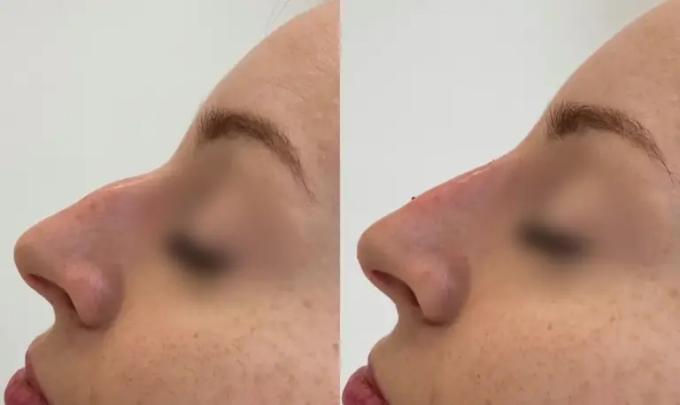 Korekta nosa kwasem hialuronowym wro