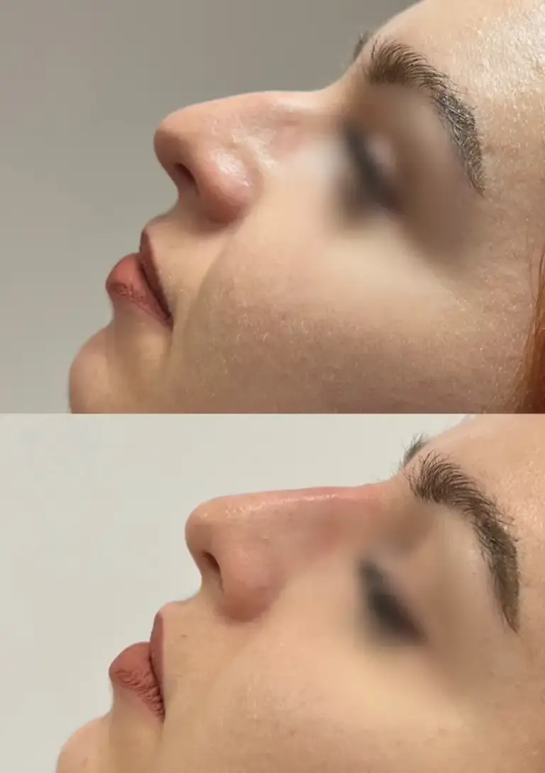 Korekta nosa kwasem hialuronowym wrocław