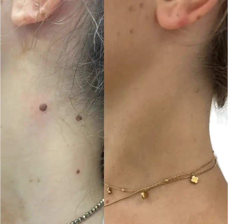 laserowe-usuwanie-znamion-wroclaw