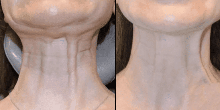 botoks-botox-na-szyje-wrocław-efekty-po-zabiegu