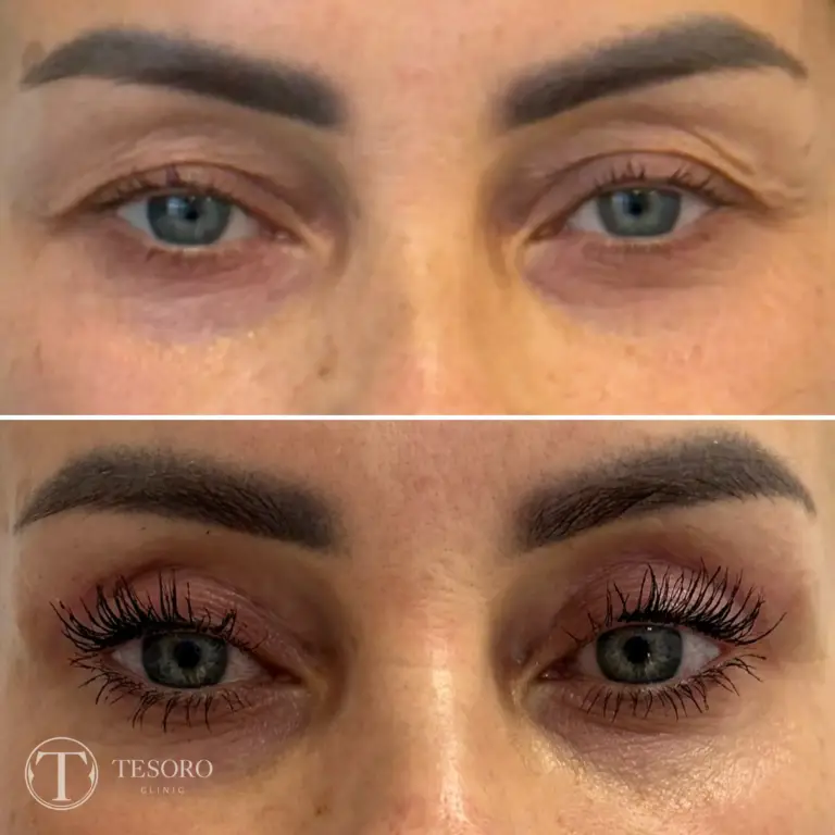 plastyka-powiek-wrocław-tesoro-clinic-01