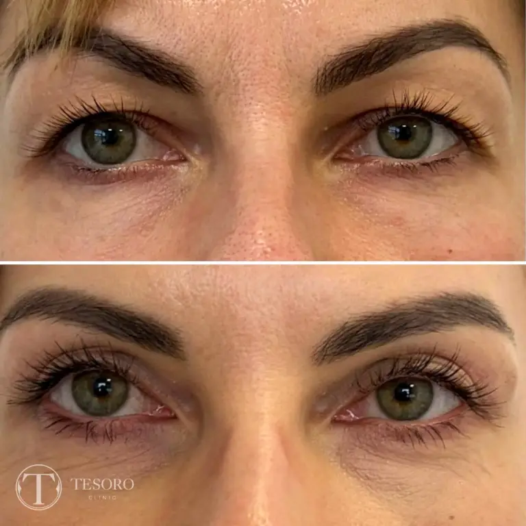 plastyka-powiek-wrocław-tesoro-clinic-15