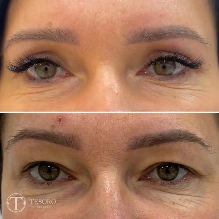 plastyka-powiek-wrocław-tesoro-clinic-25