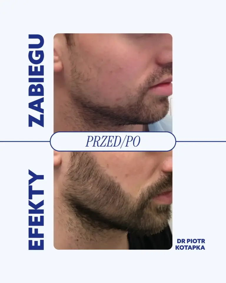 przeszczep-włosów-dolnyśląsk