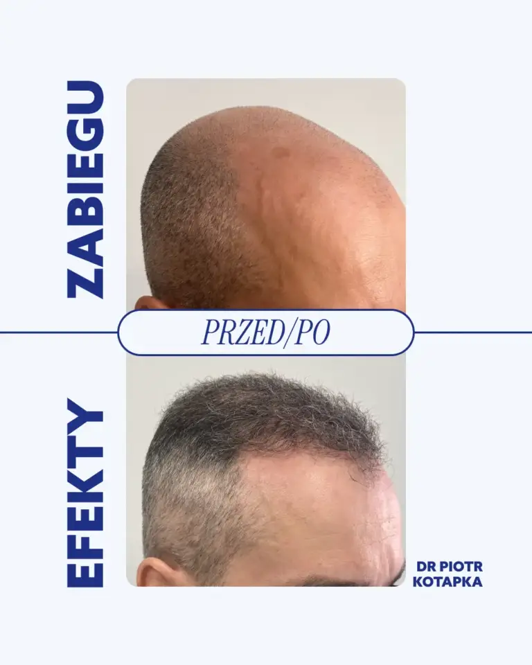przeszczep-włosów-tesoro-clinic