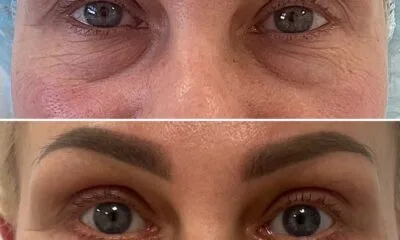 laserowa korekcja powiek