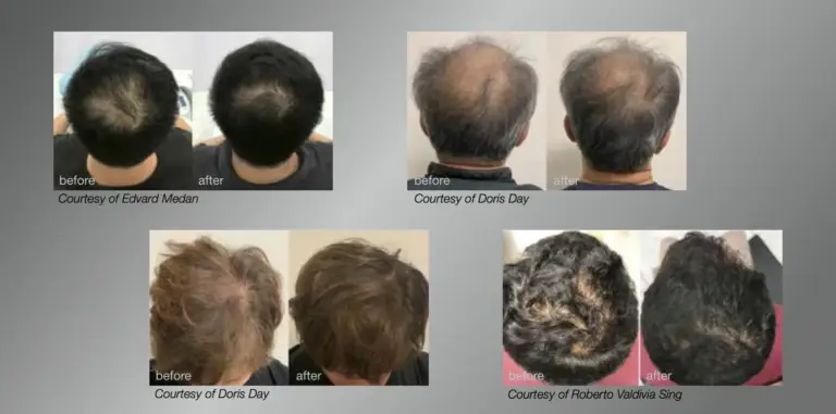 Laserowe leczenie łysienia Wrocław