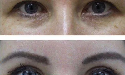 chirurgiczna korekcja powiek