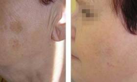 laserowe leczenie skóry