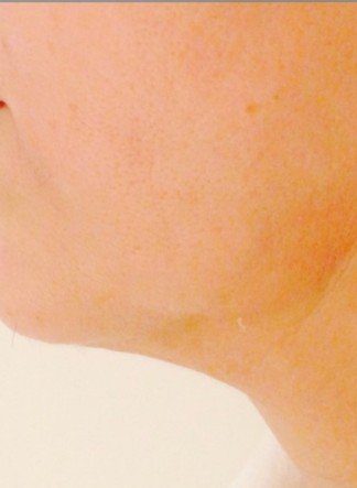 Endolift