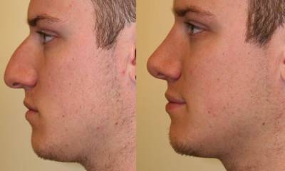 niechirurgiczna korekcja nosa