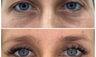 plastyka powiek dr czak wroclaw 2