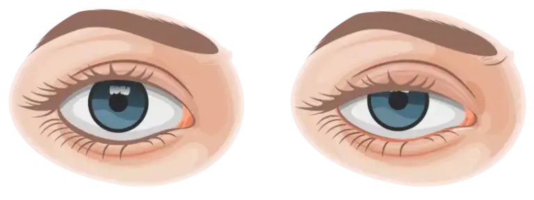 ptoza leczenie wrocław