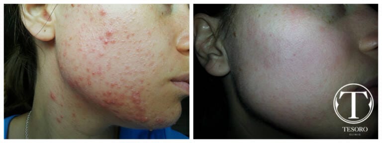 laser na trądzik wrocław