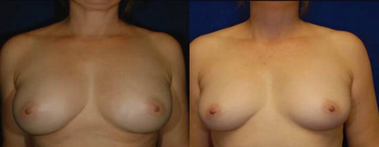 Powiększanie-piersi-własnym-tłuszczem-wrocław-2