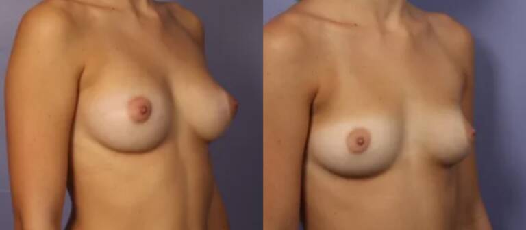 Powiększanie-piersi-własnym-tłuszczem-wrocław-5