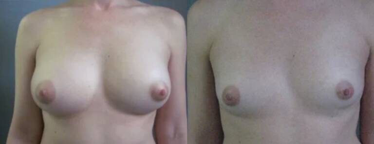 Powiększanie-piersi-własnym-tłuszczem-wrocław-6