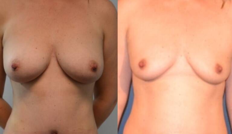 Powiększanie-piersi-własnym-tłuszczem-wrocław