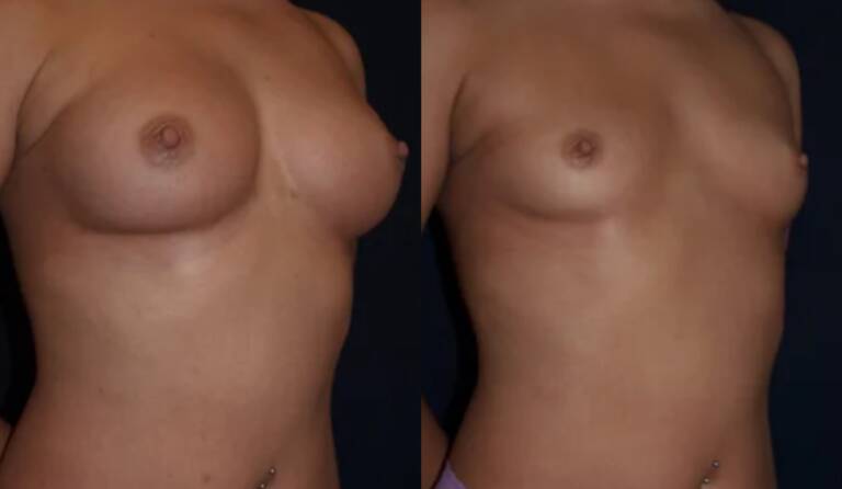 Powiększanie-piersi-wrocław-2