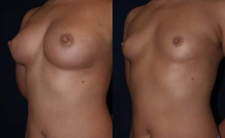 Powiększanie-piersi-wrocław-3