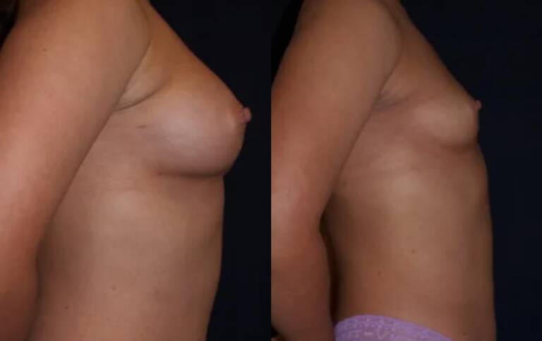 Powiększanie-piersi-wrocław-4