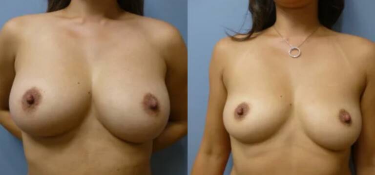 Powiększanie-piersi-wrocław-5