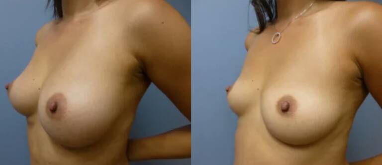 Powiększanie-piersi-wrocław-6