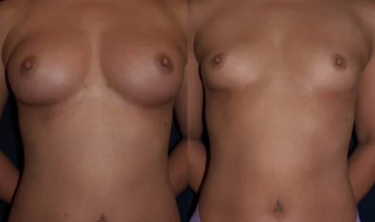 Powiększanie-piersi-wrocław