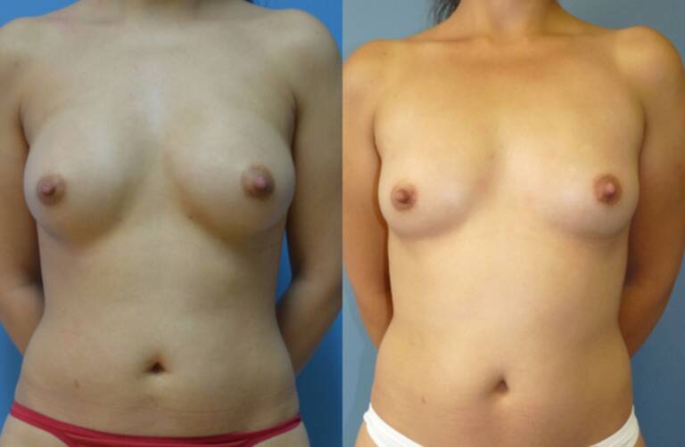 Powiększanie-piersi-wrocław-własnym-tłuszczem-efekty-2