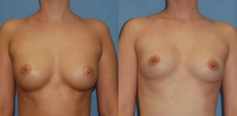Powiększanie-piersi-wrocław-własnym-tłuszczem-efekty-6