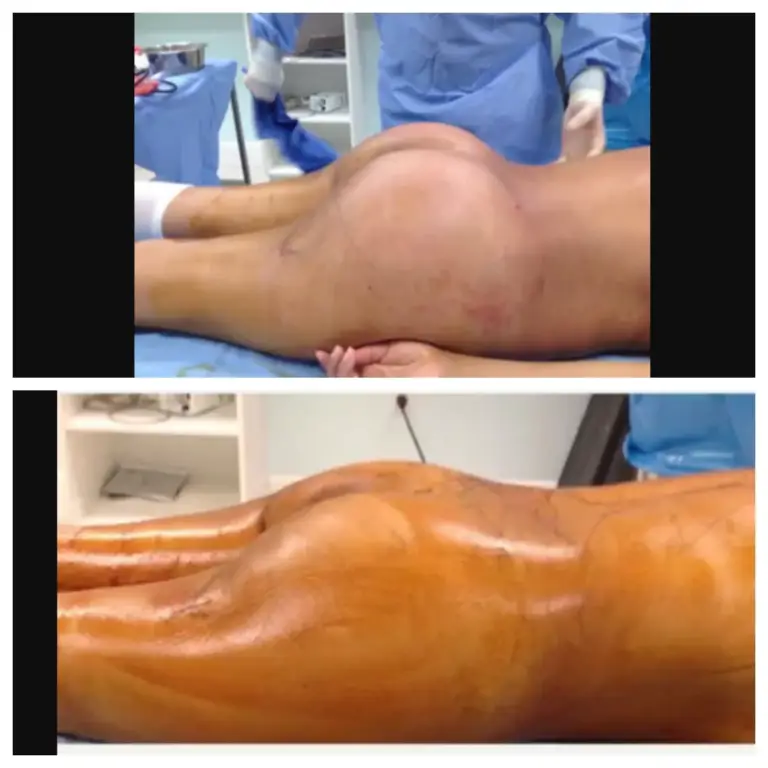 bbl-brazylijski-lifting-pośladków-11-wrocław